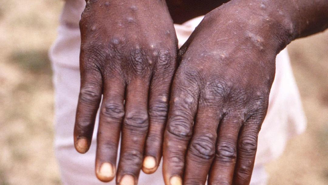 Africa: Mpox Outbreak Declared a Public Health Emergency